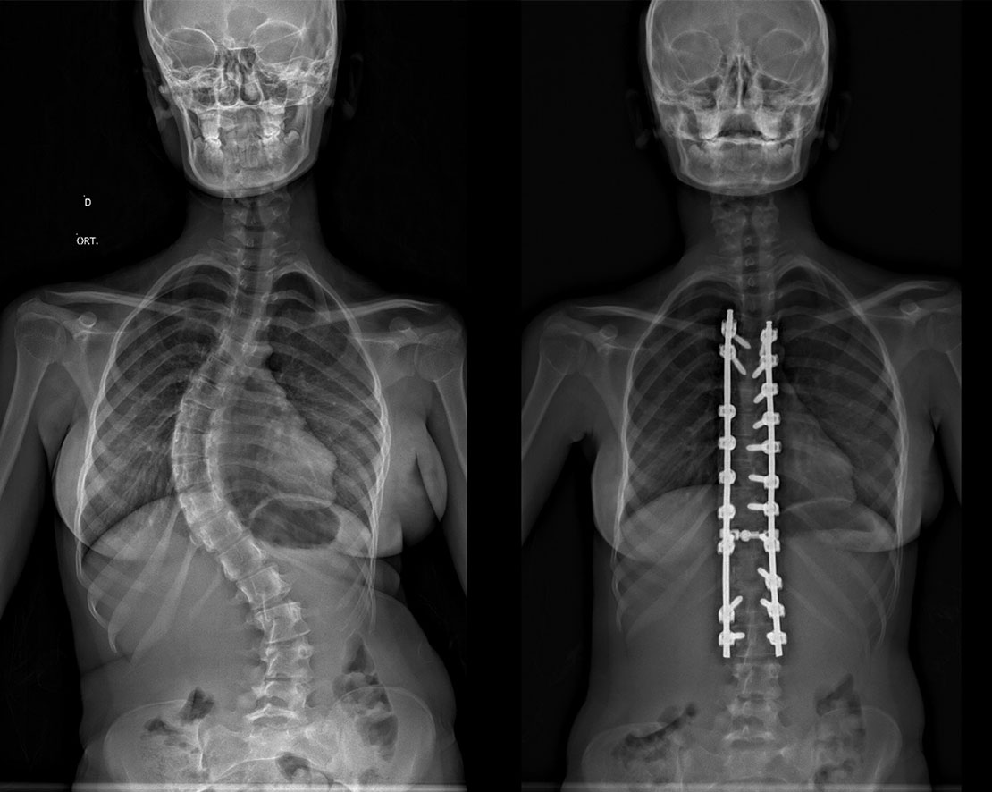 Qual a diferença entre escoliose e má postura?